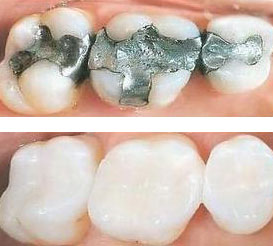 Mercury Free Fillings