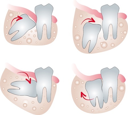 types of impacted wisdom teeth