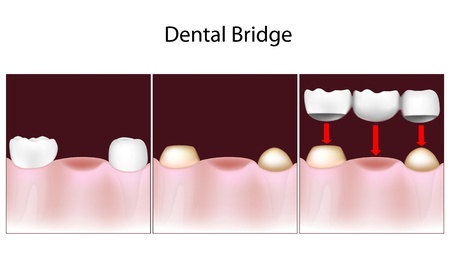 3 Unit Dental Bridge