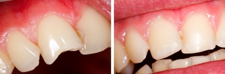 Before and After Dental Bonding