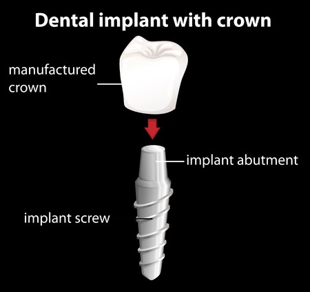 Dental Implant with crown