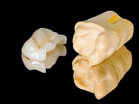 Dental Onlay Restoration