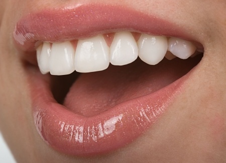 Porcelain Veneers