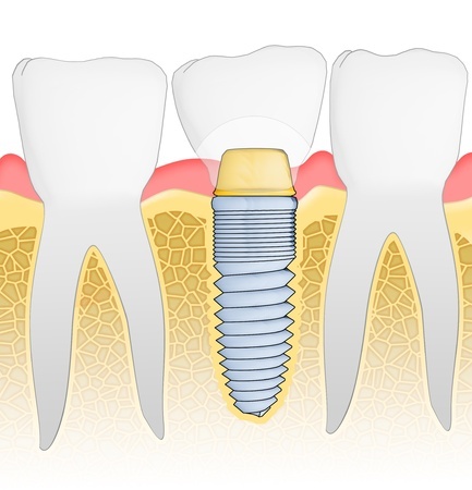 Dental Implant Placed