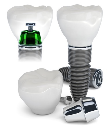 Dental Implant and Crown