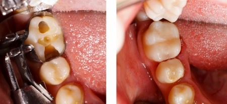Before and After Dental Composite Filling