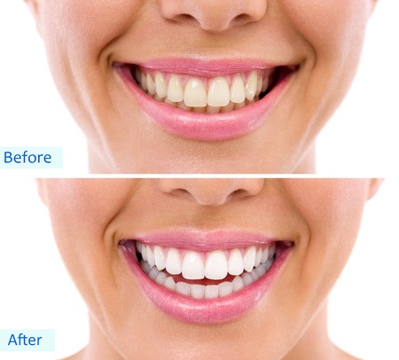 Before and After Teeth Whitening