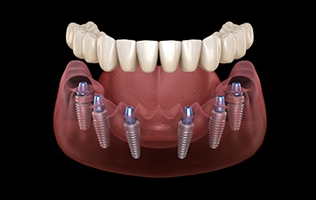 Straight Talk About Dentures and Implants